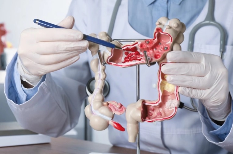  Argentina aprueba un innovador tratamiento para el cáncer colorrectal avanzado