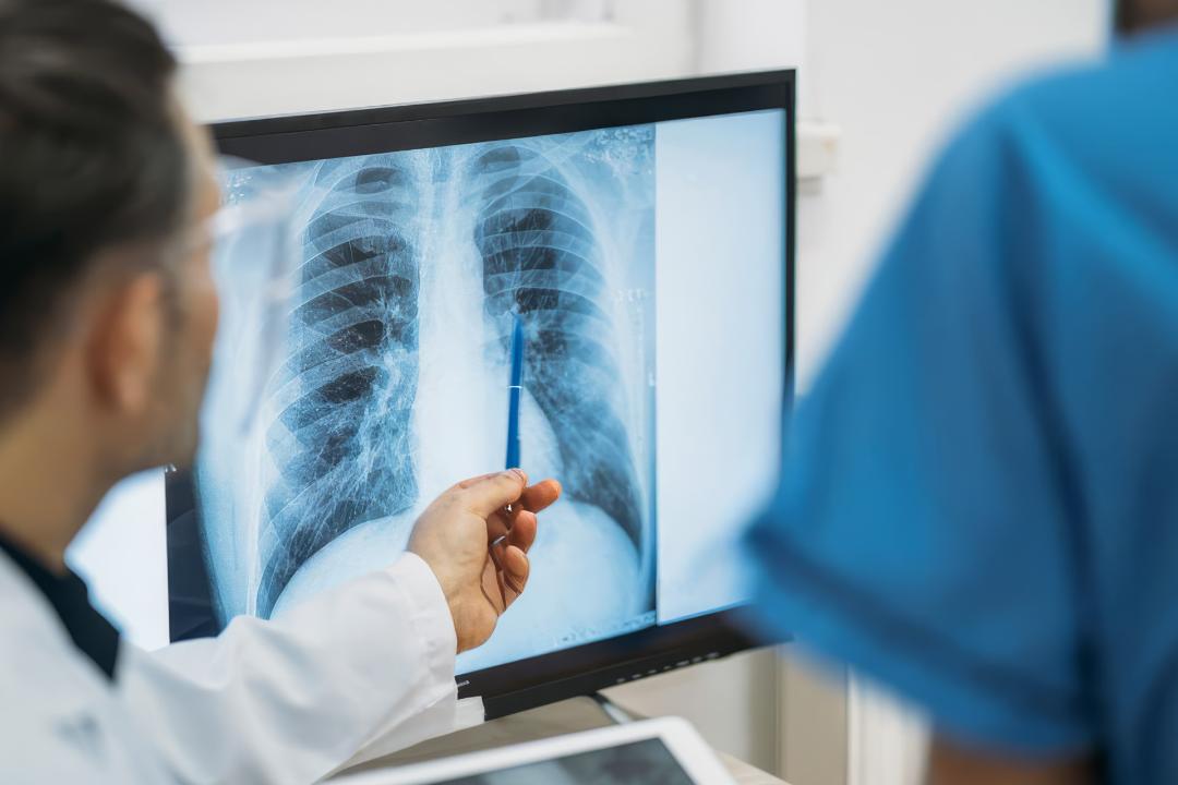  Especialistas remarcan la necesidad de detectar a tiempo el cáncer de pulmón
